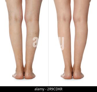 Avant et après le traitement des varices. Collage avec photos de femme montrant des jambes sur fond blanc, gros plan Banque D'Images