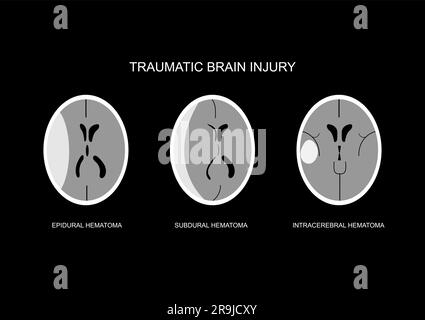 Illustration de l'imagerie TDM commune suite à une lésion cérébrale traumatique. Hématome épidural, hématome subdural aigu et hématome intracérébral. Illustration de Vecteur