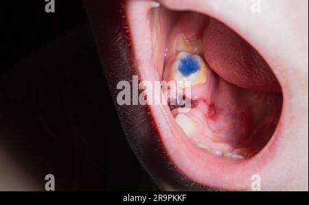 Sang dans la gomme d'une dent de lait arrachée en dentisterie chez un enfant. Extraction des dents de lait, inflammation des gencives. Remplissage bleu de la dent, Banque D'Images