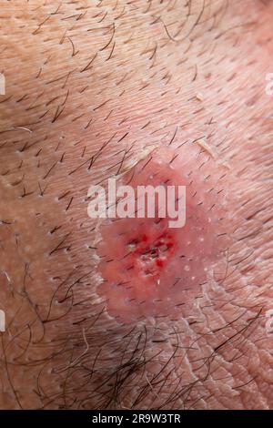 abcès inguinal avec des cheveux épais foncé, énorme blessure de furoncle sur la texture de la peau Banque D'Images