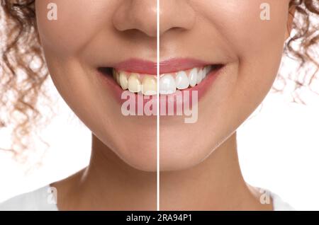 Photo de la femme divisée en deux avant et après le blanchiment des dents sur fond blanc, gros plan. Conception de collage Banque D'Images