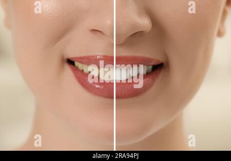 Photo de la femme divisée en deux avant et après le blanchiment des dents, gros plan. Conception de collage Banque D'Images