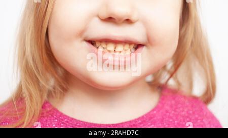 la personne sourit montre des dents plaque jaune, dents tordues, malocclusion. maladies infantiles Banque D'Images