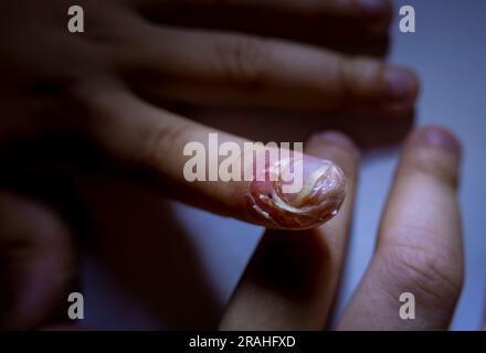 Doigt enflé avec inflammation due à une infection à ongles déchirés Banque D'Images