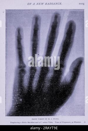 Main sous X-Ray 1895 exposition de 50 minutes de l'article DÉCOUVERTE par LE PROFESSEUR RONTGEN D'Une NOUVELLE RADIANCE. Par Michael I. Pupin du magazine Engineering CONSACRÉ AU PROGRÈS INDUSTRIEL Volume X octobre 1896 NEW YORK The Engineering Magazine Co Banque D'Images
