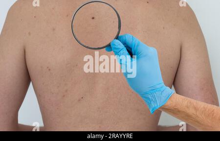 Dermatologue examinant la tache de naissance du patient avec la loupe à l'intérieur, gros plan Banque D'Images