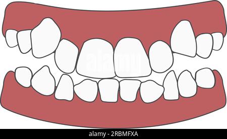 Problème orthodontique entassement des dents. Éruption anormale. Occlusion opposée, morsure ouverte, dents encombrées, caries, dentition. Illustration vectorielle isolée Illustration de Vecteur