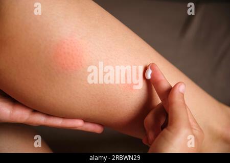 Femme appliquant la crème médicinale sur la piqûre de moustique sur sa jambe. Banque D'Images