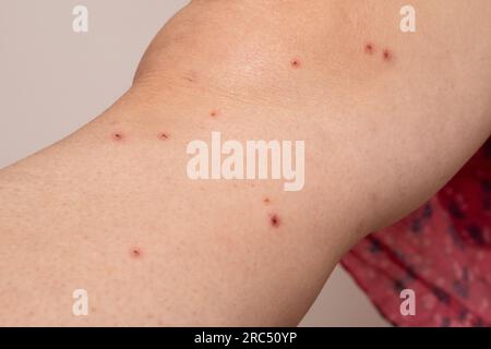 Symptômes résiduels de varicelle sur la jambe d'une femme. Croûtes rouges par pustules causées par le virus de l'herpès zoster, cause possible du zona Banque D'Images