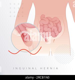 Hernie inguinale - Section des intestins - Illustration stock comme fichier EPS 10 Illustration de Vecteur