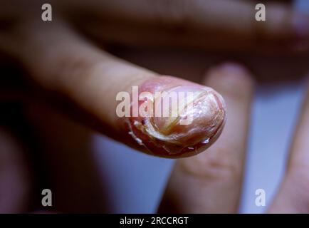 Doigt enflé avec inflammation due à une infection à ongles déchirés Banque D'Images