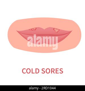 Épidémie de fièvre aphteuse d'herpès HSV sur les lèvres Illustration de Vecteur