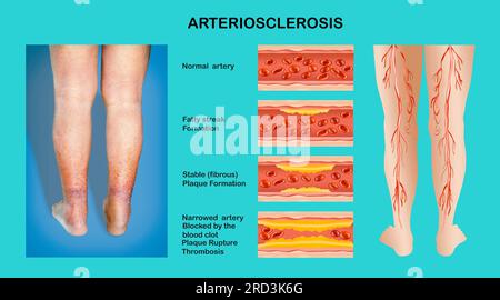 Jambes humaines. Artère avec cellules sanguines défacilité. Concept de peau sèche, personnes âgées, varices et DVT. Banque D'Images