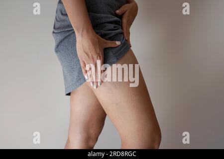 Varices douloureuses sur les jambes de la femme Banque D'Images