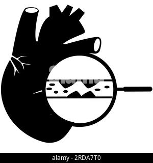 Cholestérol dans les vaisseaux sanguins humains et icône du coeur. Signe ldl élevé. Symbole artères obstruées. Logo Heart Attack. Concept d'infarctus du myocarde. styl plat Banque D'Images