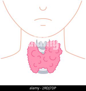 Hypertrophie de la glande thyroïde, illustration Banque D'Images