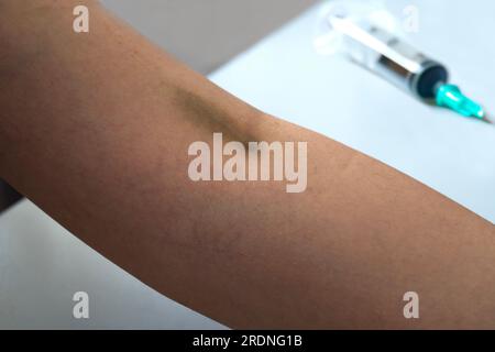 Hématome veineux après prélèvement sanguin Banque D'Images