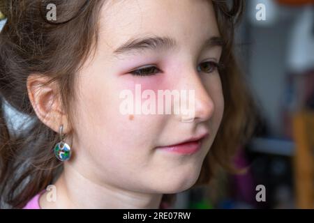 Une paupière gonflée rouge sur le visage d'un enfant en gros plan est une allergie à une piqûre d'insecte. Réaction allergique aux insectes suceurs de sang Banque D'Images