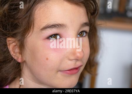 Une paupière gonflée rouge sur le visage d'un enfant en gros plan est une allergie à une piqûre d'insecte. Réaction allergique aux insectes suceurs de sang Banque D'Images