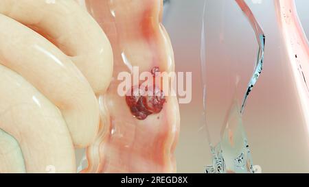 Cancer de l'intestin ou tumeur colorectale, cancer du côlon, maladie intestinale inflammatoire, douleur intestinale, coeliaque, infections, duplication, cellules en expansion Banque D'Images