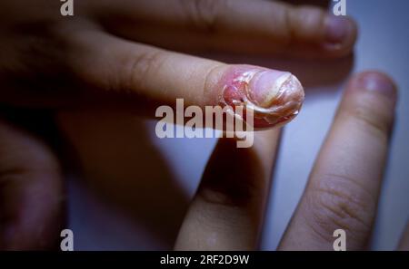 Doigt enflé avec inflammation due à une infection à ongles déchirés Banque D'Images