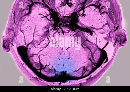 Thrombose des sinus veineux cérébraux de la dure-mère, visualisée par angiographie cranienne en IRM. Banque D'Images