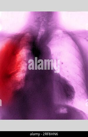 Cancer du poumon (à droite), visualisé par une radiographie thoracique AP. Banque D'Images