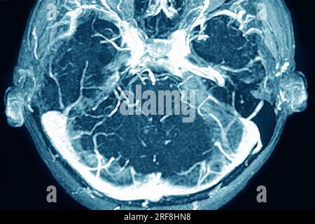 Thrombose des sinus veineux cérébraux de la dure-mère, visualisée par angiographie cranienne en IRM. Banque D'Images