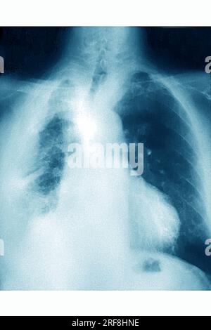 Cancer du poumon (à droite), visualisé par une radiographie thoracique AP. Banque D'Images