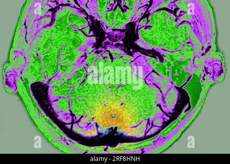 Thrombose des sinus veineux cérébraux de la dure-mère, visualisée par angiographie cranienne en IRM. Banque D'Images