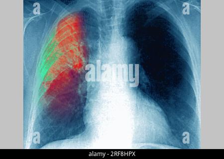 Pneumonie du poumon droit (infection respiratoire aiguë) révélée par une radiographie thoracique frontale. Banque D'Images