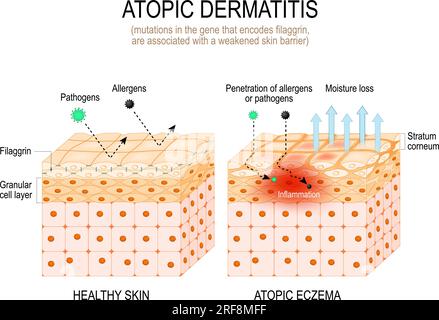 Dermatite atopique. Théorie filaggrine et eczéma atopique. les mutations dans le gène qui code la filaggrine, sont associées à une barrière cutanée affaiblie. Illustration de Vecteur