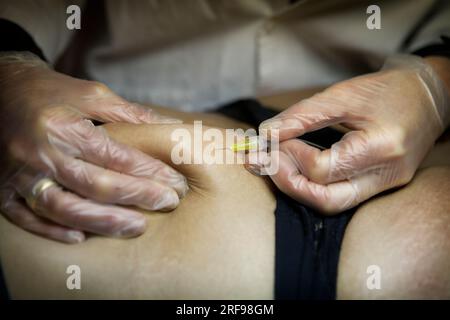 Traitement de la cellulite et des vergetures par carboxythérapie, ou injection sous-cutanée de dioxyde de carbone. Banque D'Images