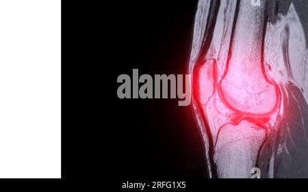 Imagerie par résonance magnétique ou IRM de la PDW sagittale de l'articulation du genou pour détecter la déchirure ou l'entorse du ligament croisé antérieur (LCA) Banque D'Images