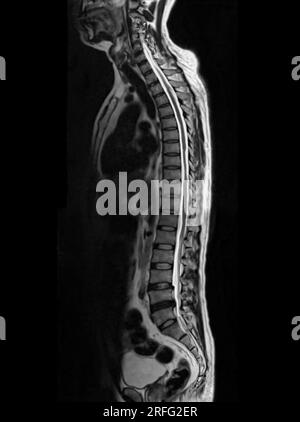 IRM du plan sagittal T2W de la colonne vertébrale entière pour la compression diagnostique de la moelle épinière. Banque D'Images