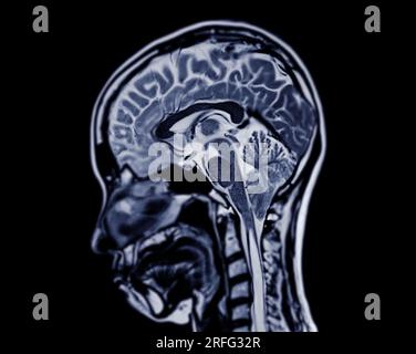 Plan sagittal de balayage de cerveau d'IRM pour détecter les maladies du cerveau comme les maladies d'accident vasculaire cérébral, les tumeurs du cerveau et les infections. Banque D'Images