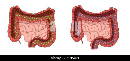 Mauvaises bactéries et bonnes bactéries. Une illustration du biome humain dans le gros intestin. Banque D'Images
