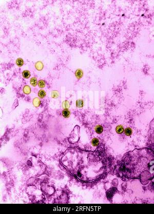 Micrographie électronique de transmission (TEM) révélant la présence de nombreux virions du virus d'Epstein-Barr (EBV). Banque D'Images