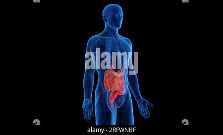 Intestins atteints de maladie de Crohn, illustration Banque D'Images