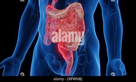 Intestins atteints de maladie de Crohn, illustration Banque D'Images