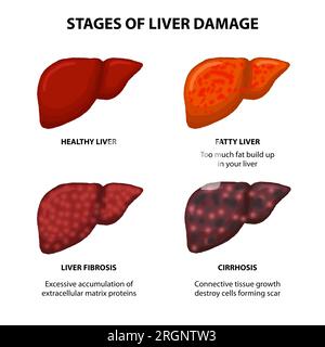Stades des lésions hépatiques illustration foie sain, foie gras et fibrose hépatique. Banque D'Images