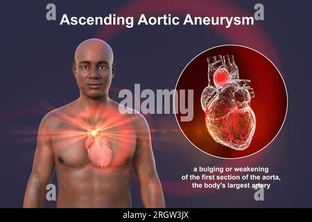 Anévrysme de l'aorte ascendante, illustration Banque D'Images