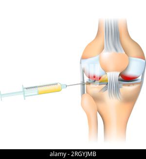 Traitement de l'arthrose. Seringue et articulation du genou humain avec inflammation. Injection de PRP. traitement des douleurs articulaires. procédé de régénération du genou. Vecteur Illustration de Vecteur