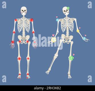 Guérison d'une maladie auto-immune, articulations saines. Squelette humain à points douloureux dans la polyarthrite rhumatoïde. Illustration anatomique homme avec une silhouette de corps. Illustration plate isolée vectorielle du crâne Illustration de Vecteur