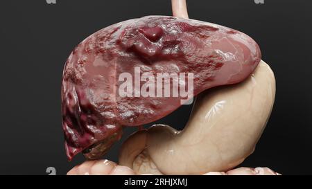 Cancer du foie d'organe digestif, hépatite cirrhose tumeur maligne, insuffisance hépatique, cellules en croissance, duplication, fibrose, cirrhose, hépatocellulaire ca Banque D'Images