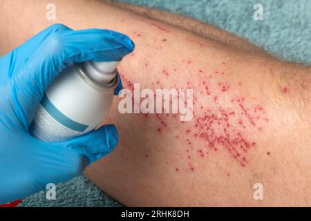 La main du médecin applique de la mousse désinfectante sur la jambe. Un médecin traite une blessure à la jambe d'un cycliste qui est tombé de son vélo avec de la mousse désinfectante et du coton Banque D'Images