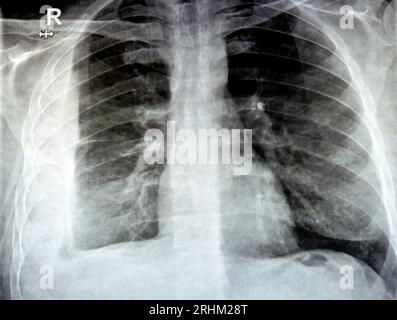 Radiographie simple pour un patient atteint d'une pneumonie par aspiration du poumon droit, d'un empyème, d'un épanchement pleural après insertion d'un tube de thoracostomie thoracique pour drainer l'up Banque D'Images