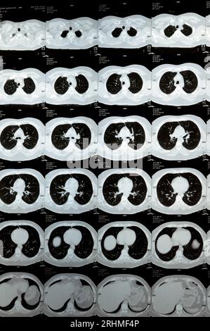 TDM multi-coupes du thorax montrant une étude normale, un aspect normal des poumons, un parenchyme, une vascularisation pulmonaire, des structures médiastinales, non Banque D'Images