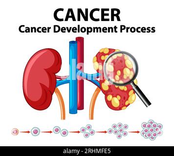 Infographie illustrée illustrant le processus de développement du cancer sur le rein humain Illustration de Vecteur