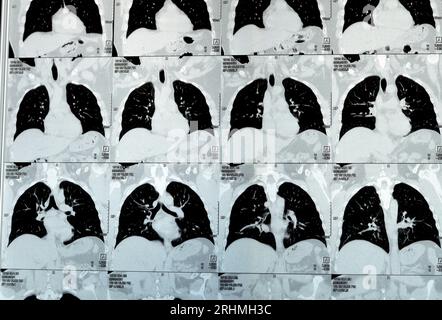 TDM multi-coupes du thorax montrant une étude normale, un aspect normal des poumons, un parenchyme, une vascularisation pulmonaire, des structures médiastinales, non Banque D'Images